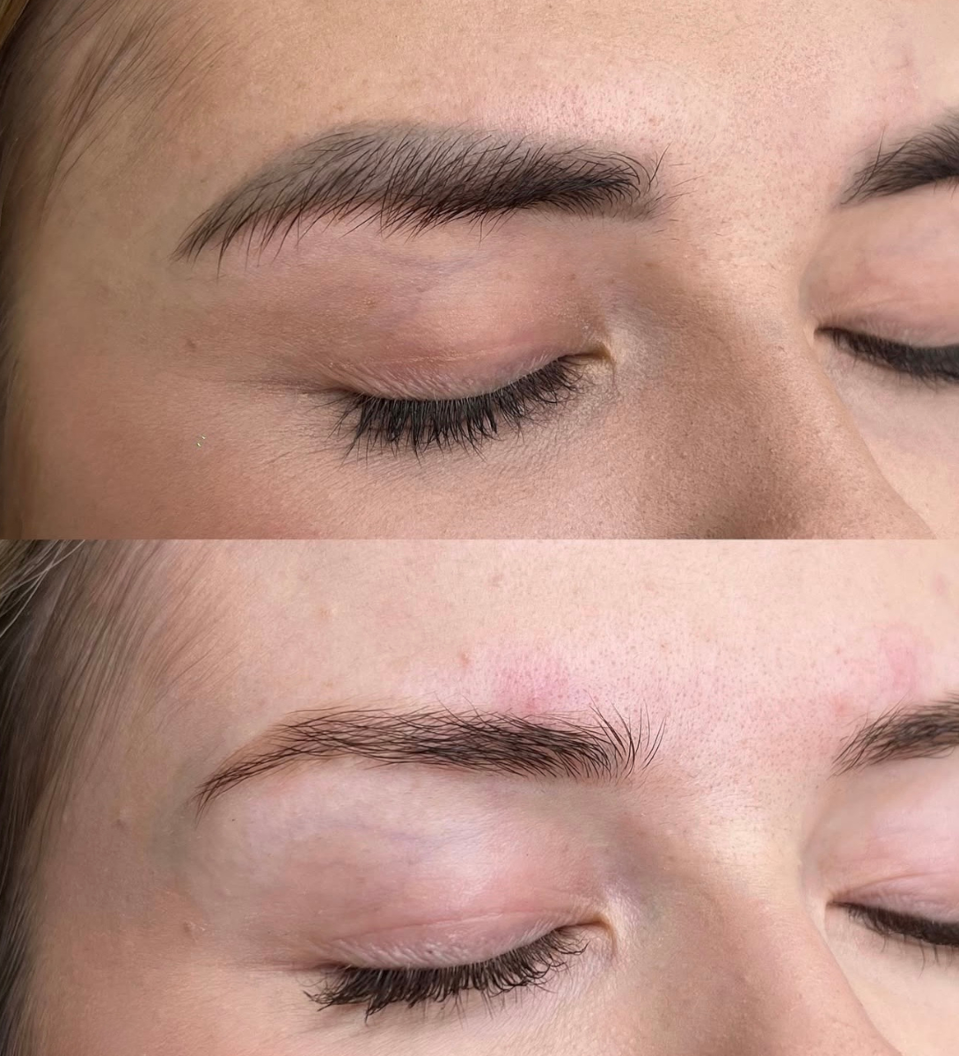 laser and non-laser cosmetic tattoo removal