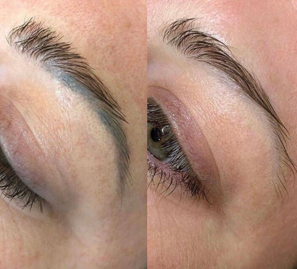 laser and non-laser cosmetic tattoo removal
