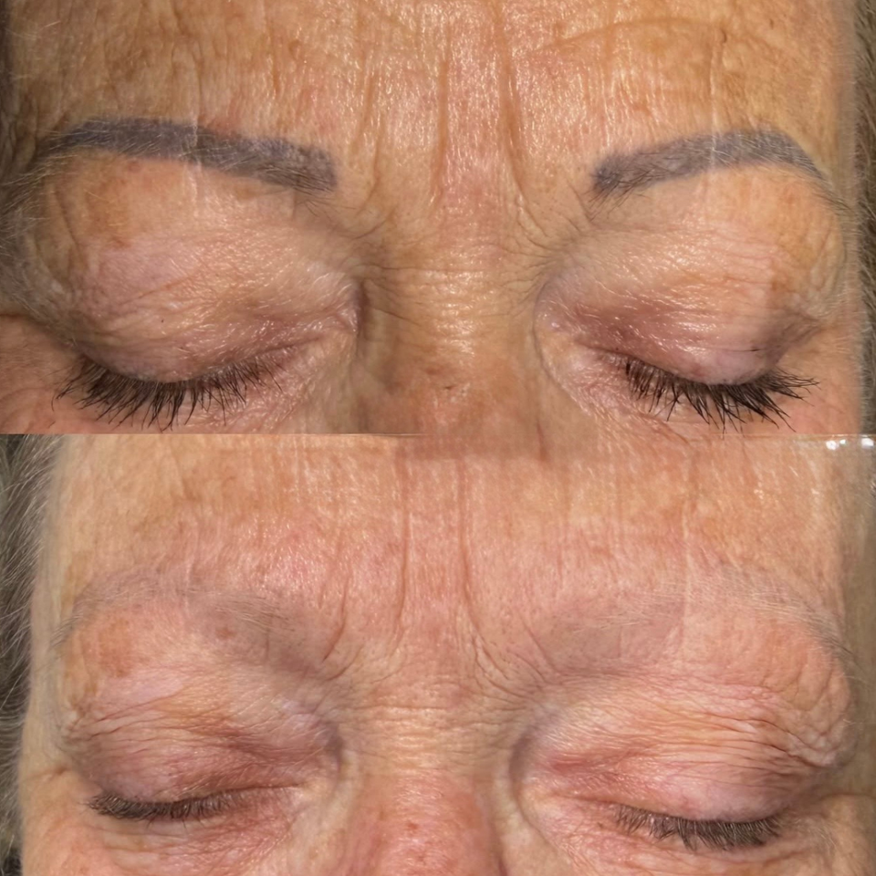 laser and non-laser cosmetic tattoo removal