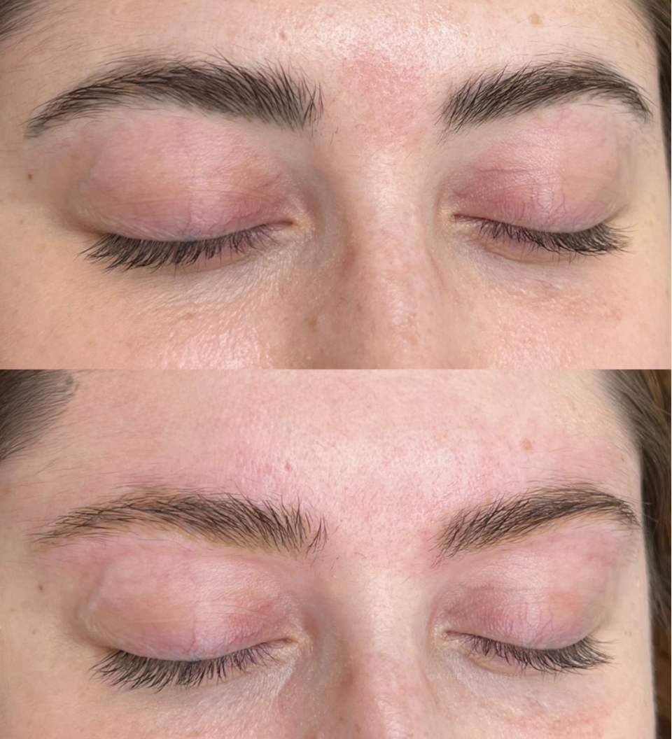laser and non-laser cosmetic tattoo removal