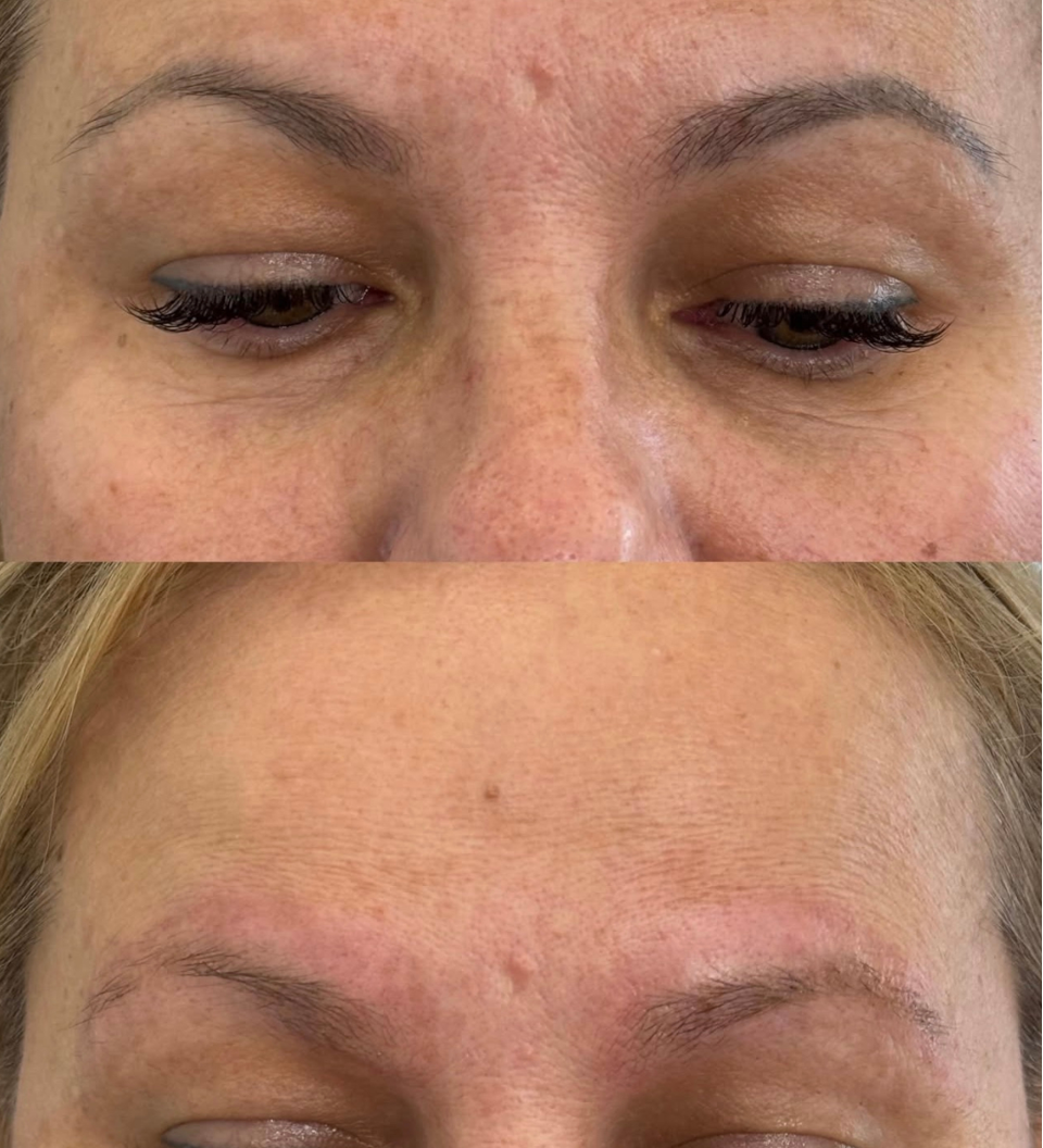 laser and non-laser cosmetic tattoo removal