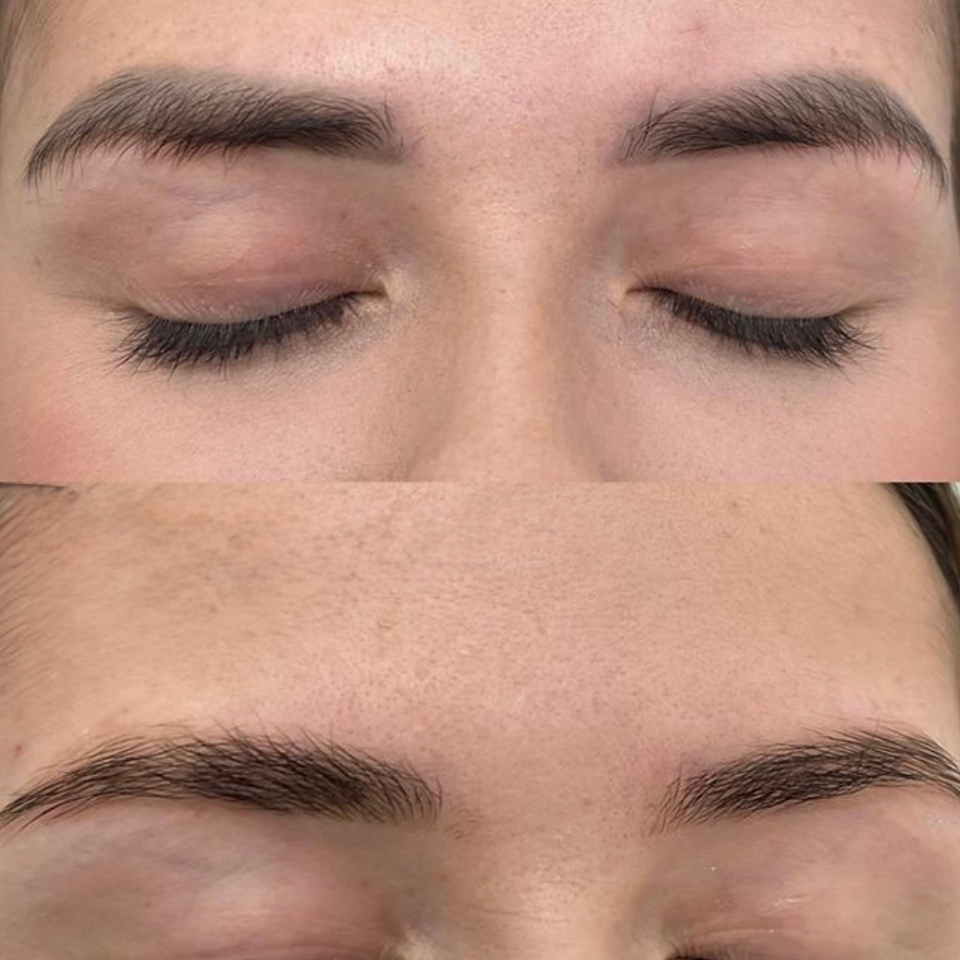 laser and non-laser cosmetic tattoo removal